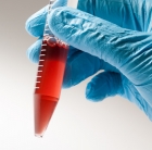 Blood biomarker predicts type 2 diabetes risk up to 19 years before onset